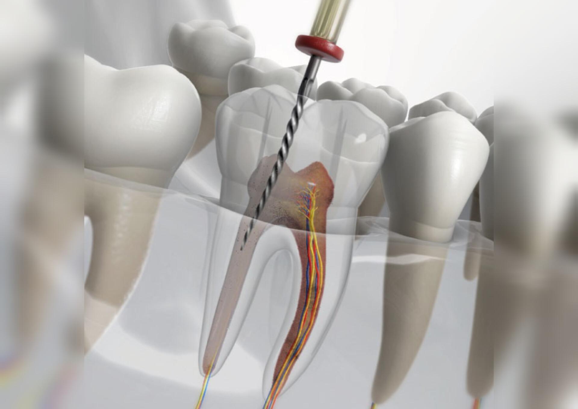 مراحل درمان ریشه دندان: از تشخیص تا بهبودی کامل