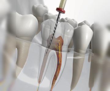 مراحل درمان ریشه دندان: از تشخیص تا بهبودی کامل